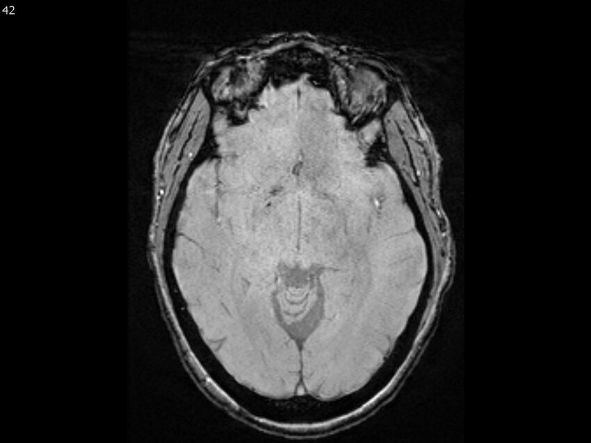 Atypical meningioma - intraosseous (Radiopaedia 64915-74572 Axial SWI 42).jpg