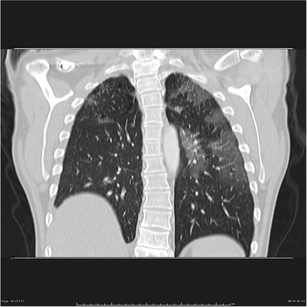File:Atypical pneumonia - Q fever (Radiopaedia 21993-21989 C 33).jpg