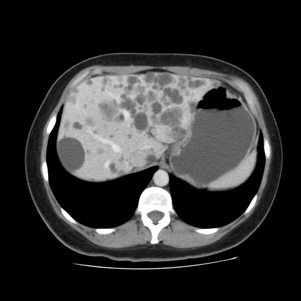 File:Autosomal dominant polycystic kidney disease (Radiopaedia 23061-23093 C 12).jpg
