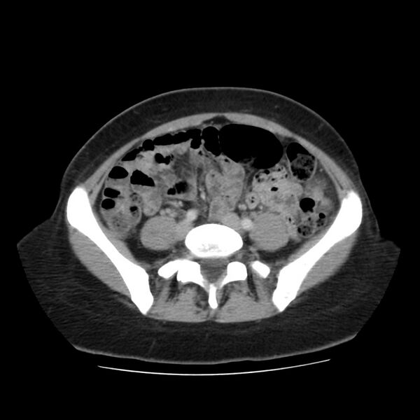 File:Autosomal dominant polycystic kidney disease (Radiopaedia 23061-23093 C 48).jpg