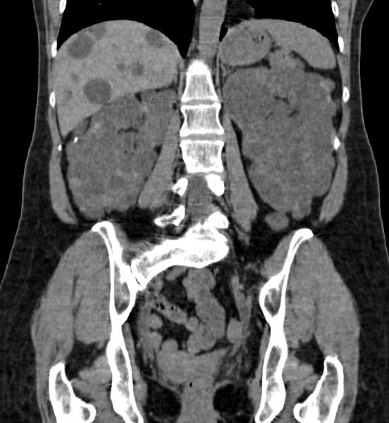File:Autosomal dominant polycystic kidney disease (Radiopaedia 41918-44922 Coronal non-contrast 31).jpg