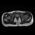 Avascular necrosis of the hip (Radiopaedia 29563-30067 Axial T2 10).jpg
