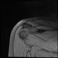 Avulsion fracture - greater tuberosity of humerus (Radiopaedia 71216-81515 Coronal T2 6).jpg