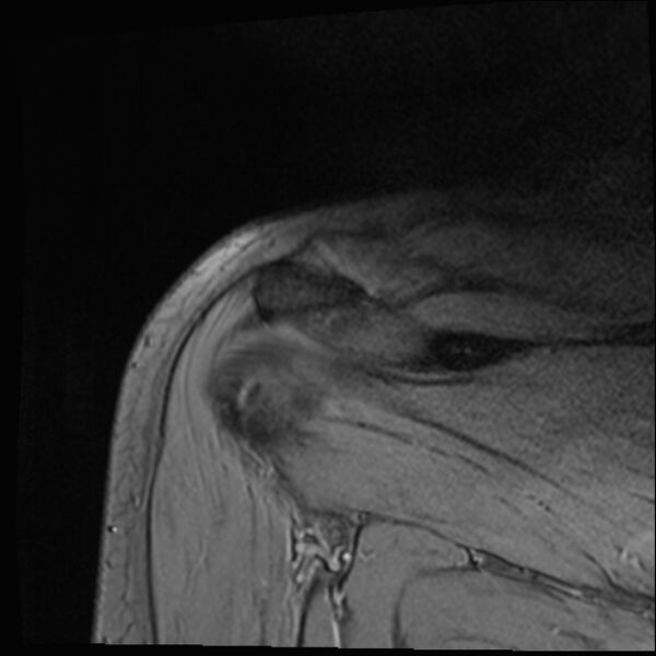 File:Avulsion fracture - greater tuberosity of humerus (Radiopaedia 71216-81515 Coronal T2 6).jpg