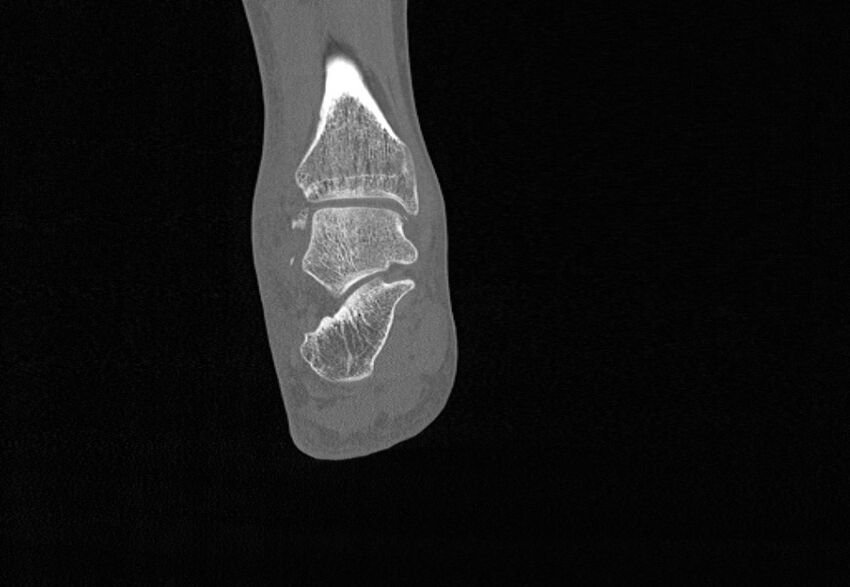 Avulsion fractures of talus and calcaneus (Radiopaedia 48277-53155 Coronal bone window 66).jpg