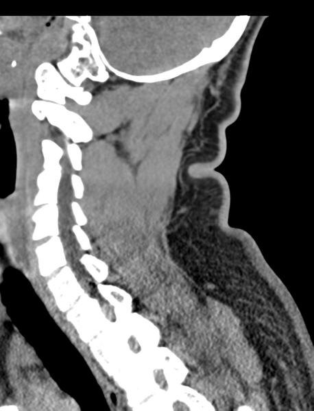 File:Axis peg fracture (type 3) and atlas lateral mass (type 4) fracture (Radiopaedia 37474-39324 D 46).png