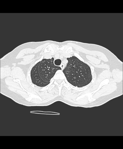 File:Azygos fissure and azygos lobe (Radiopaedia 41841-44832 Axial lung window 29).jpg