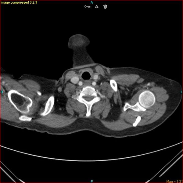 File:Azygos vein aneurysm (Radiopaedia 77824-90130 B 3).jpg