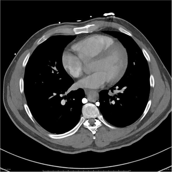File:Azygos venous system anatomy (CT pulmonary angiography) (Radiopaedia 25928-26077 Axial C+ CTPA 55).jpg