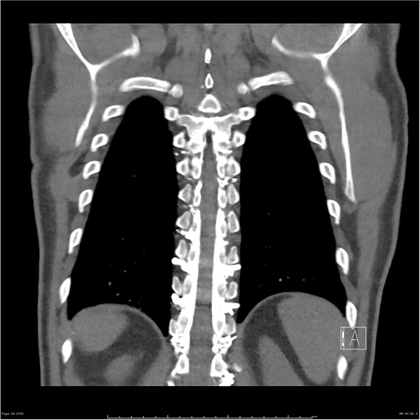 Azygos venous system anatomy (CT pulmonary angiography) (Radiopaedia 25928-26077 Coronal C+ CTPA 65).jpg