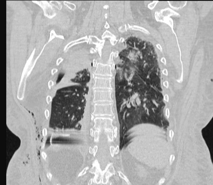 File:Barotrauma due to mechanical ventilation (Radiopaedia 28079-28336 Coronal lung window 72).jpg