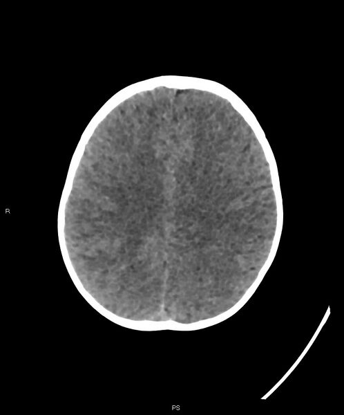 File:Basal ganglia and parenchymal ischemia (Radiopaedia 45818-50083 Axial non-contrast 14).jpg