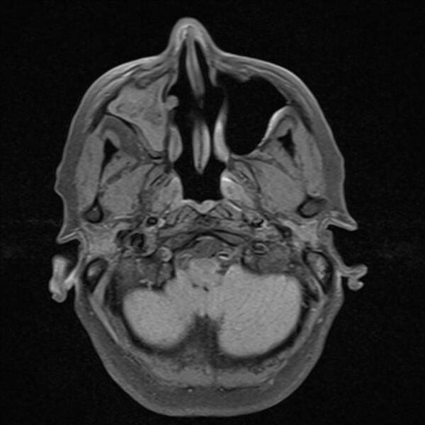 File:Base of skull chondrosarcoma (Radiopaedia 30410-31070 Axial T1 fat sat 3).jpg
