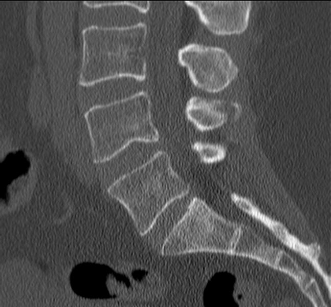 File:Bertolotti syndrome (Radiopaedia 24864-25128 Sagittal bone window 27).jpg