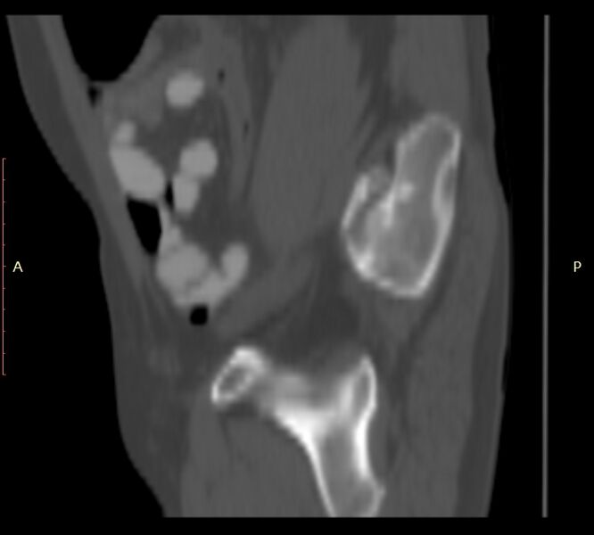 File:Bertolotti syndrome (Radiopaedia 58974-66235 Sagittal bone window 54).jpg