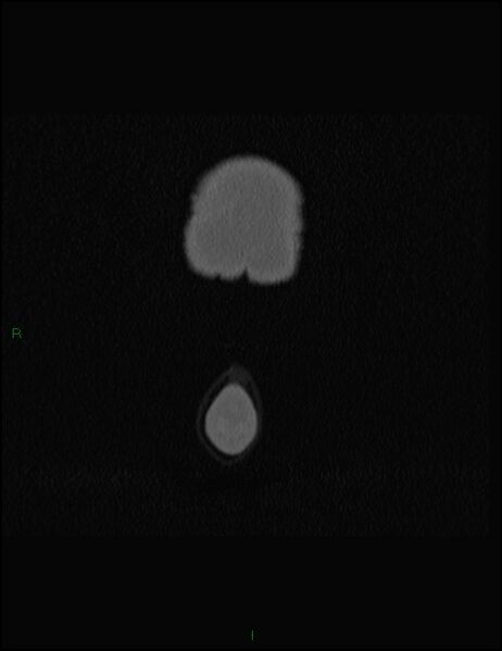File:Bilateral frontal mucoceles (Radiopaedia 82352-96454 Coronal 8).jpg
