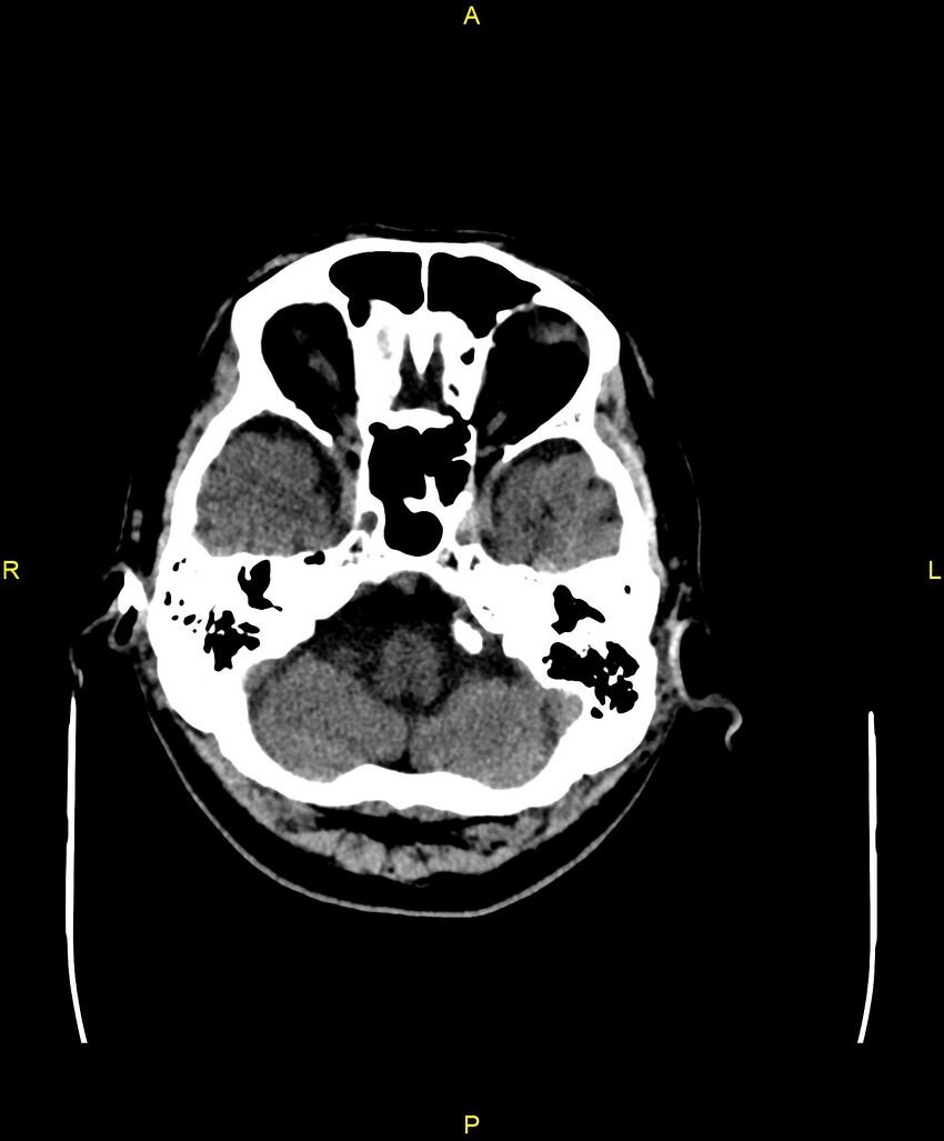 Bilateral isodense subdural hematomas (Radiopaedia 88621-105325 Axial non-contrast 19).jpg
