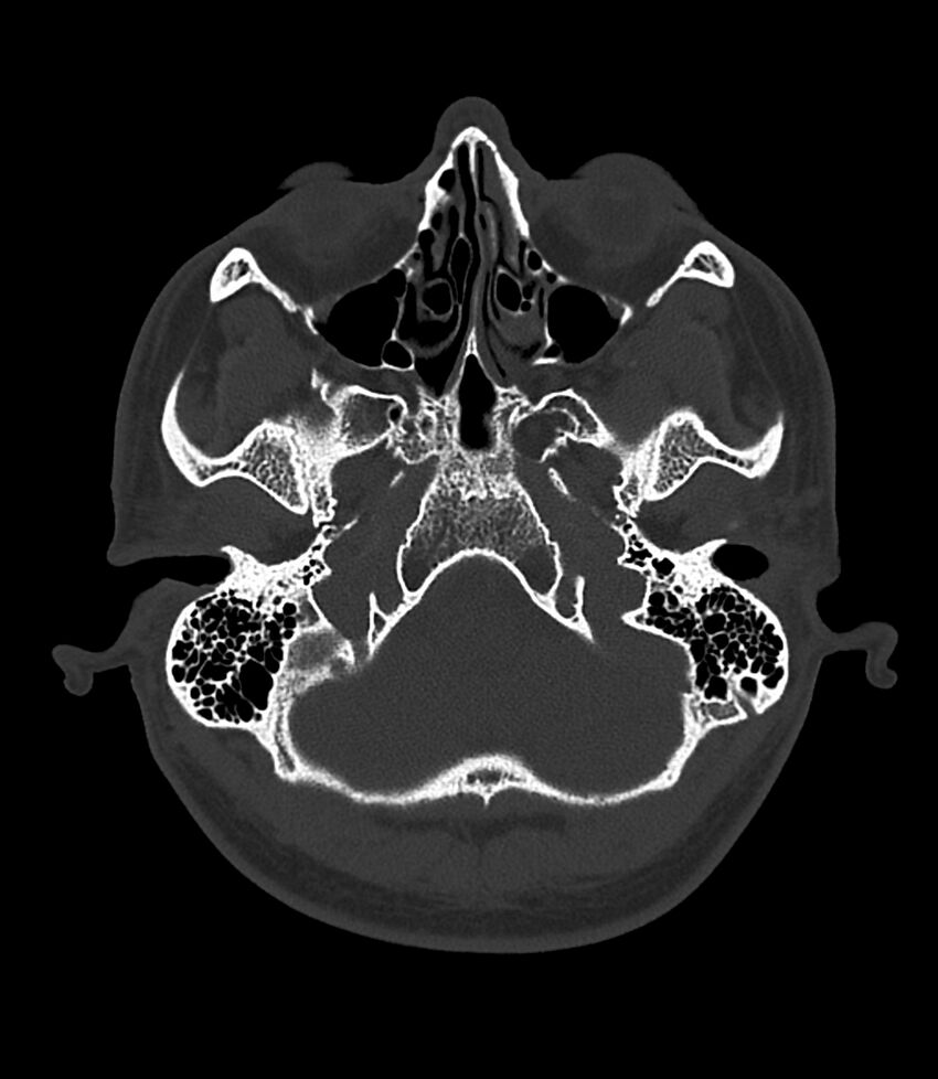 Bilateral medial canal fibrosis (Radiopaedia 85598-101344 Axial bone window 2).jpg