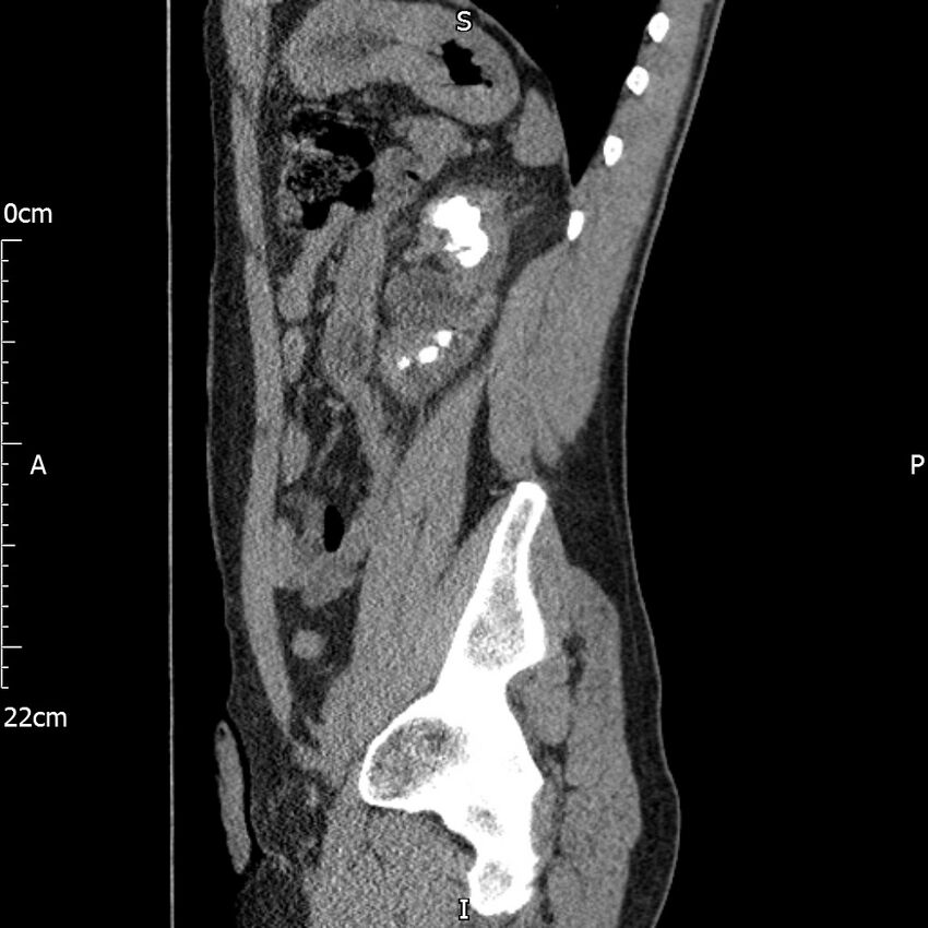 Bilateral medullary nephrocalcinosis with ureteric calculi (Radiopaedia 71269-81569 C 41).jpg