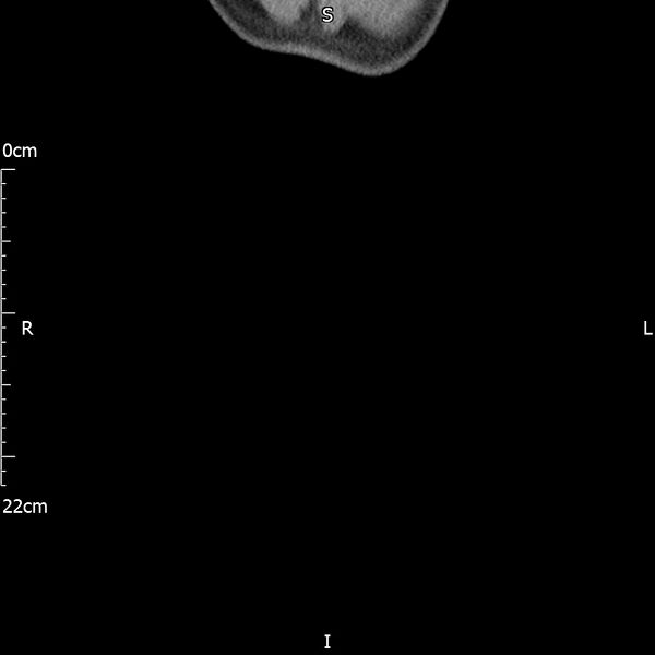 File:Bilateral medullary nephrocalcinosis with ureteric calculi (Radiopaedia 71269-81569 Coronal non-contrast 84).jpg