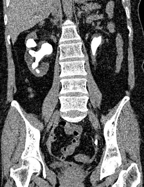 File:Bilateral staghorn calculi (Radiopaedia 59475-66842 Coronal non-contrast 64).jpg