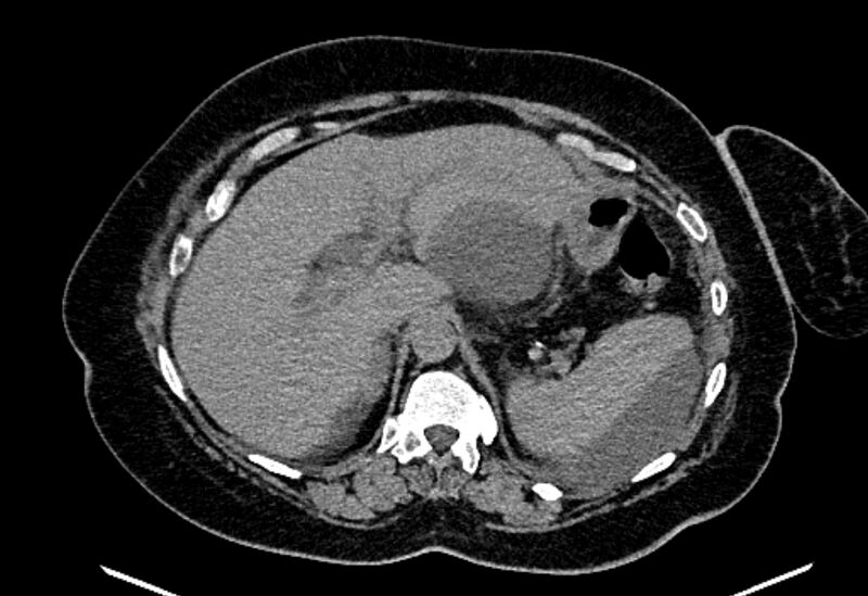 File:Biliary pancreatitis (Radiopaedia 72289-82823 Axial non-contrast 74).jpg