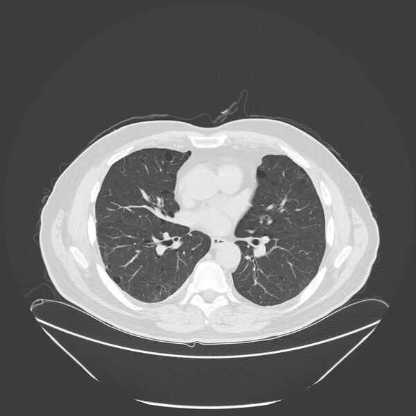 File:Birt-Hogg-Dubé syndrome (Radiopaedia 52578-58491 Axial lung window 33).jpg