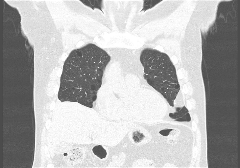 File:Birt-Hogg-Dubé syndrome (Radiopaedia 52578-58491 Coronal lung window 10).jpg