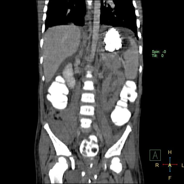 File:Blunt abdominal trauma (Radiopaedia 24780-25044 C 13).jpg