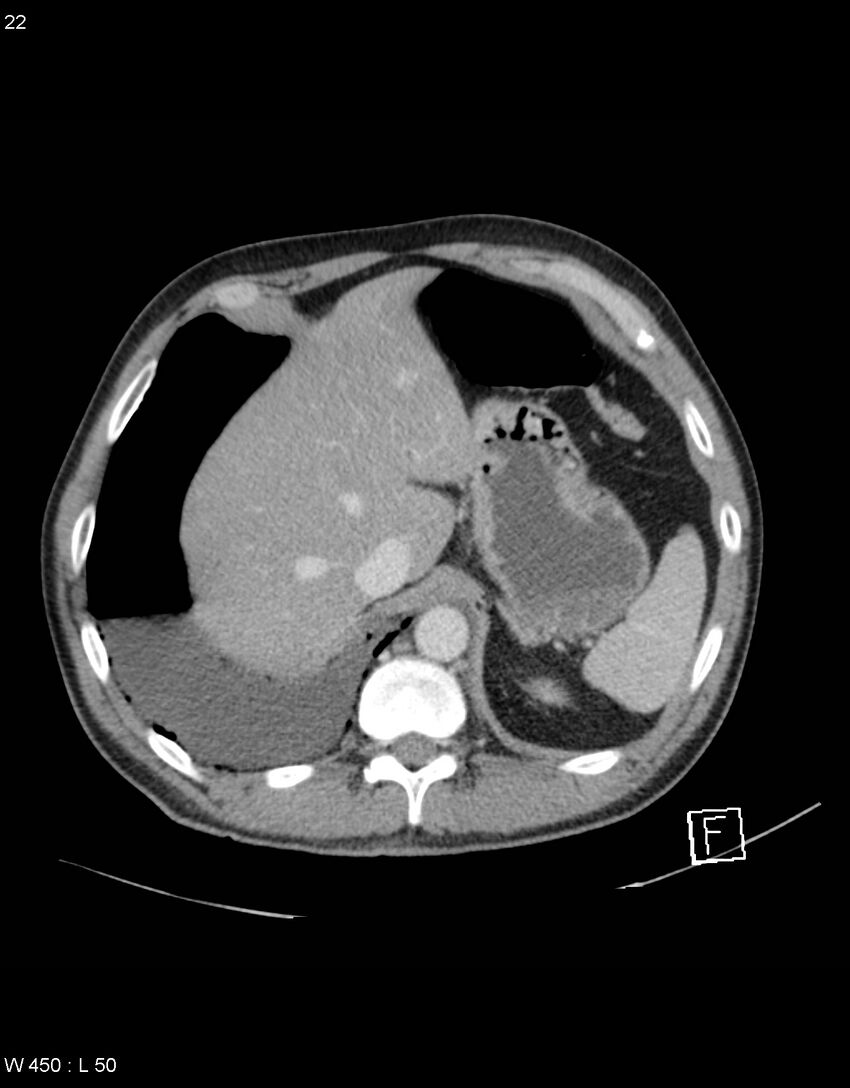 Boerhaave syndrome with tension pneumothorax (Radiopaedia 56794-63603 A 11).jpg