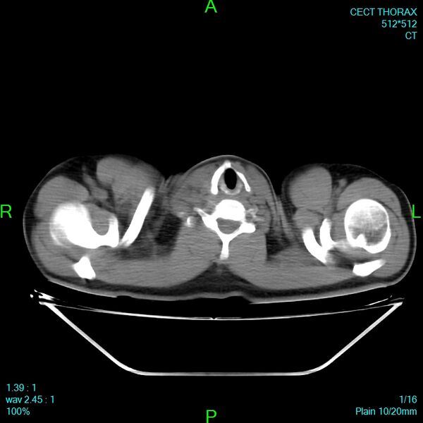File:Bone metastases from lung carcinoma (Radiopaedia 54703-60937 Axial non-contrast 1).jpg