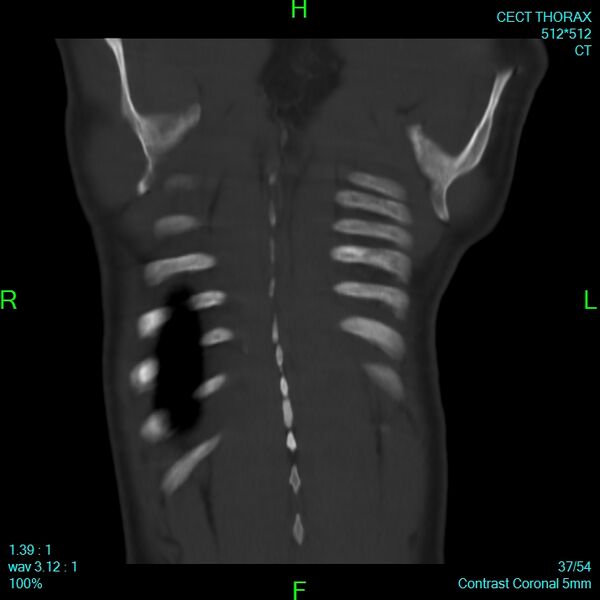 File:Bone metastases from lung carcinoma (Radiopaedia 54703-60937 Coronal bone window 37).jpg
