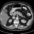 Bosniak cyst - type IV (Radiopaedia 23525-23627 renal cortical phase 10).jpg