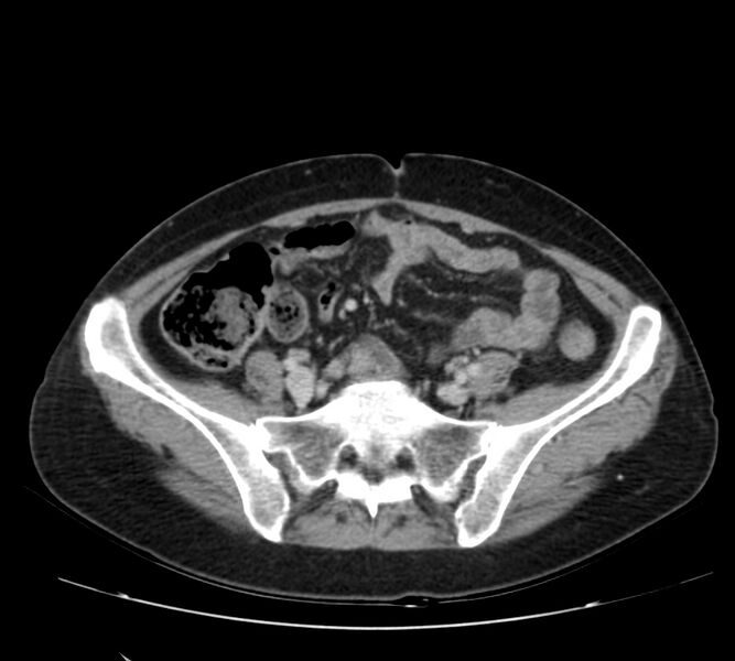 File:Bosniak renal cyst - type IV (Radiopaedia 22929-22953 C 48).jpg