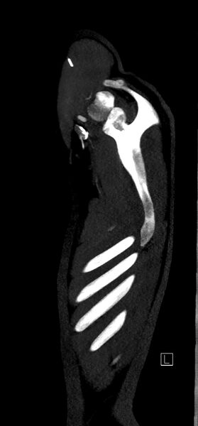 File:Brachiocephalic trunk pseudoaneurysm (Radiopaedia 70978-81191 C 4).jpg
