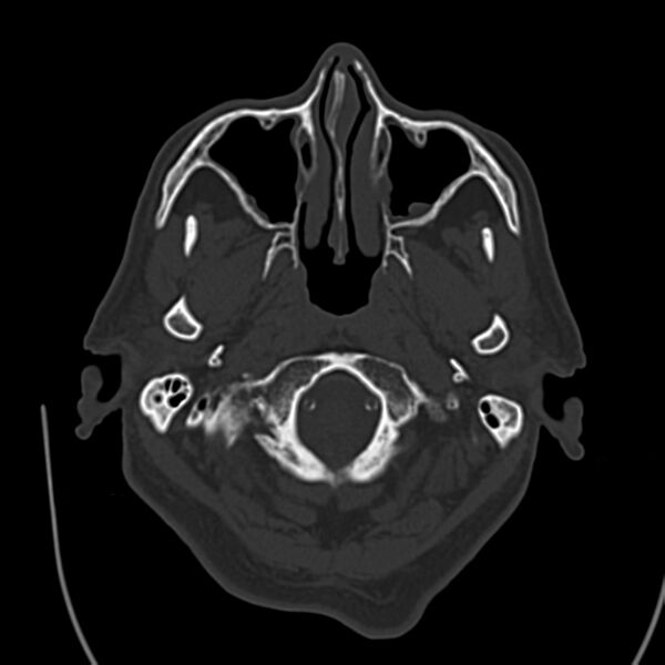 File:Brain Pantopaque remnants (Radiopaedia 78403-91048 Axial bone window 14).jpg