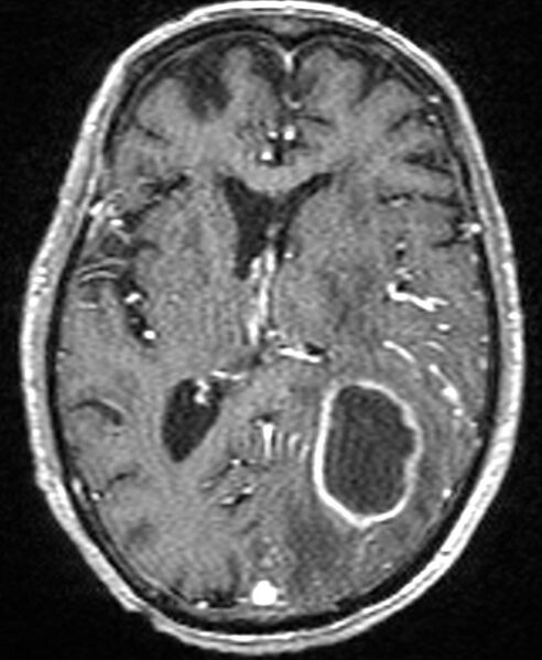 File:Brain abscess with dual rim sign (Radiopaedia 87566-103938 Axial T1 C+ 90).jpg