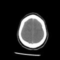 Brain death (Radiopaedia 78597-91360 Axial non-contrast 54).jpg
