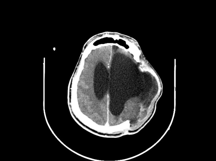 Brain injury by firearm projectile (Radiopaedia 82068-96088 B 156).jpg