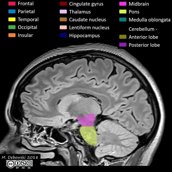 File:Brain lobes - annotated MRI (Radiopaedia 61691-69700 Sagittal 33).JPG