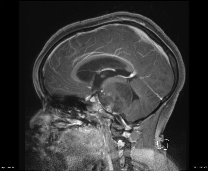 File:Brainstem glioma (Radiopaedia 21819-21775 D 23).jpg