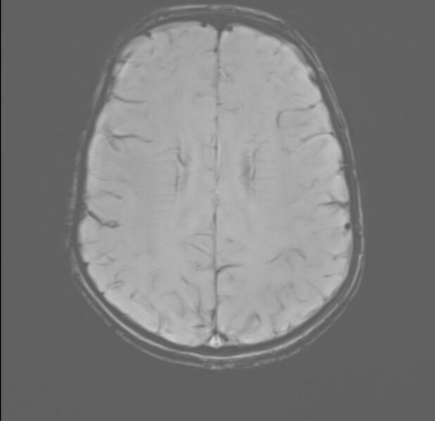 File:Brainstem glioma (Radiopaedia 70548-80674 Axial SWI 43).jpg