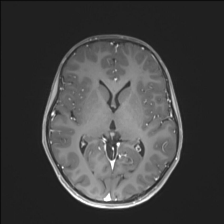 Brainstem glioma (Radiopaedia 70548-80674 Axial T1 C+ 83).jpg