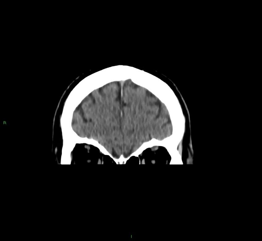 Brainstem hemorrhage (Radiopaedia 58794-66028 Coronal non-contrast 54).jpg