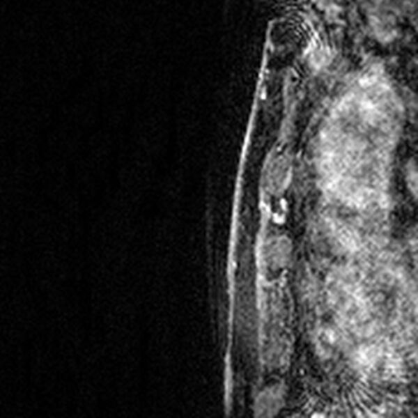 File:Breast implants - MRI (Radiopaedia 26864-27035 Sagittal T2 70).jpg