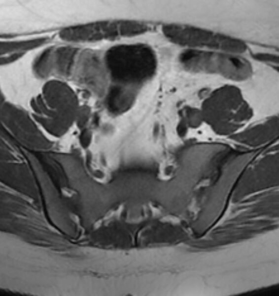 File:Broad ligament leiomyoma (Radiopaedia 81634-95516 Axial T1 4).jpg
