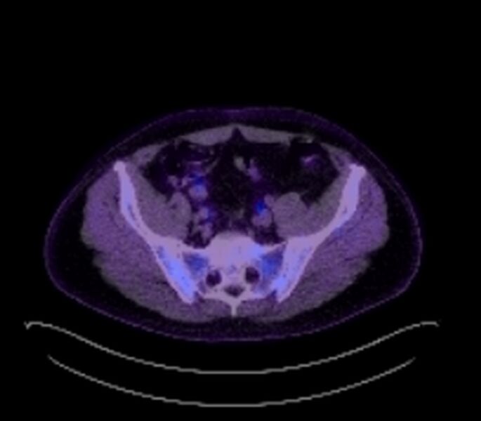 File:Bronchial carcinoid tumor (Radiopaedia 67377-76766 18FDG-PET-CT 54).jpg