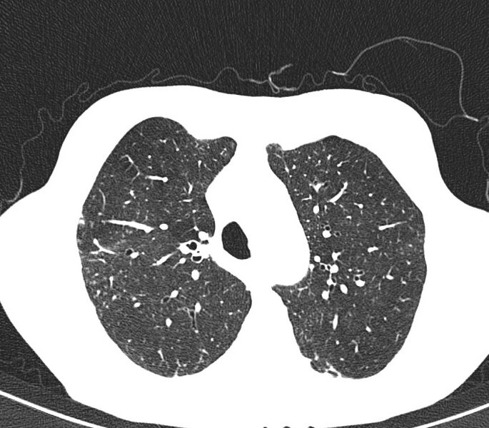 File:Bronchiolitis (Radiopaedia 24616-24887 Axial lung window 13).jpg