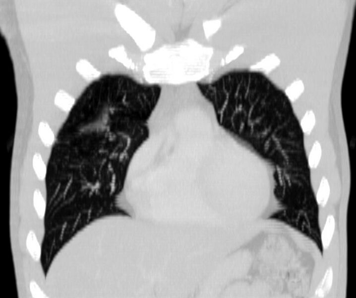 File:Bronchocele (Radiopaedia 12104-12460 Coronal lung window 4).jpg