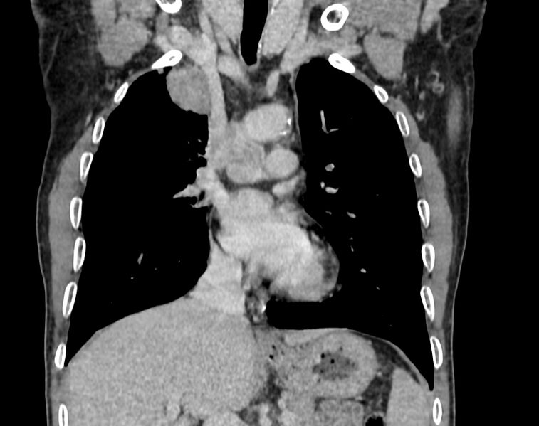 File:Bronchogenic carcinoma with superior vena cava syndrome (Radiopaedia 36497-38054 Coronal C+ delayed 31).jpg